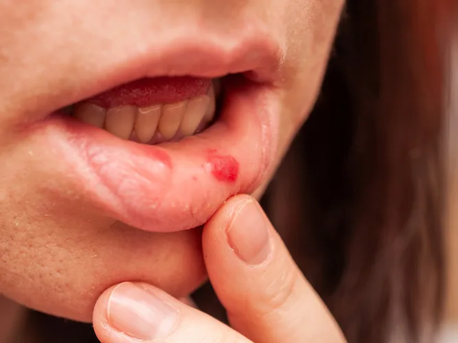 Cold sores